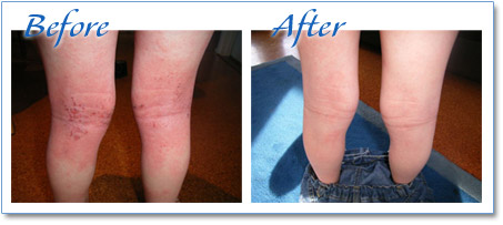 Eczema on the Legs - treat with Eczema Cream